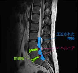 治る のか ヘルニア 手術しなくても治るヘルニアと手術しても再発するヘルニア