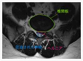 腰椎椎間板ヘルニア 整形外科とブロック注射の専門外来 江戸川区小岩駅前の整形外科 かおるペインクリニック