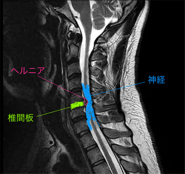椎間板 ヘルニア 頚椎 頚椎椎間板ヘルニアについて