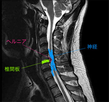 頚椎椎間板ヘルニア 整形外科とブロック注射の専門外来 江戸川区小岩駅前の整形外科 かおるペインクリニック